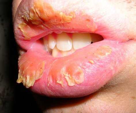 Sore and dry lips