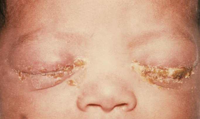 A sty (stye) is a red bump that develops on your child’s eyelid