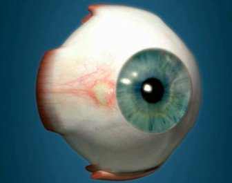 A pinguecula is a noncancerous growth - Bump on Eyeball