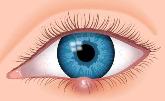 A stye is a red painful bump that develops on the edge of the eyelid