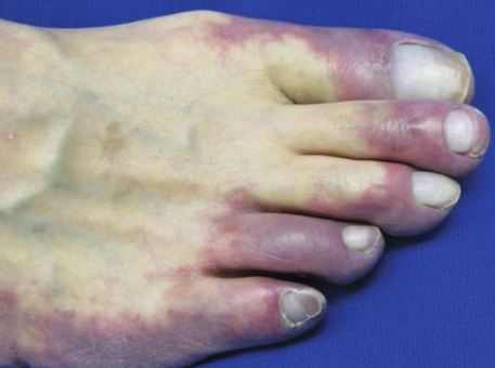 Discoloration of toes and fingertips can be a sign of diabetes