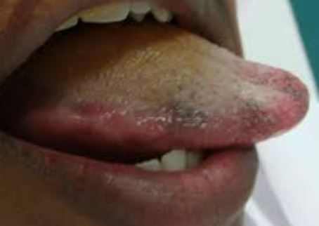 Black-spots-on-side-of-tongue