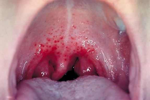 Bleeding tonsils and uvula