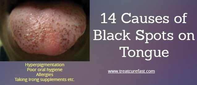What causes black spots on the tongue?