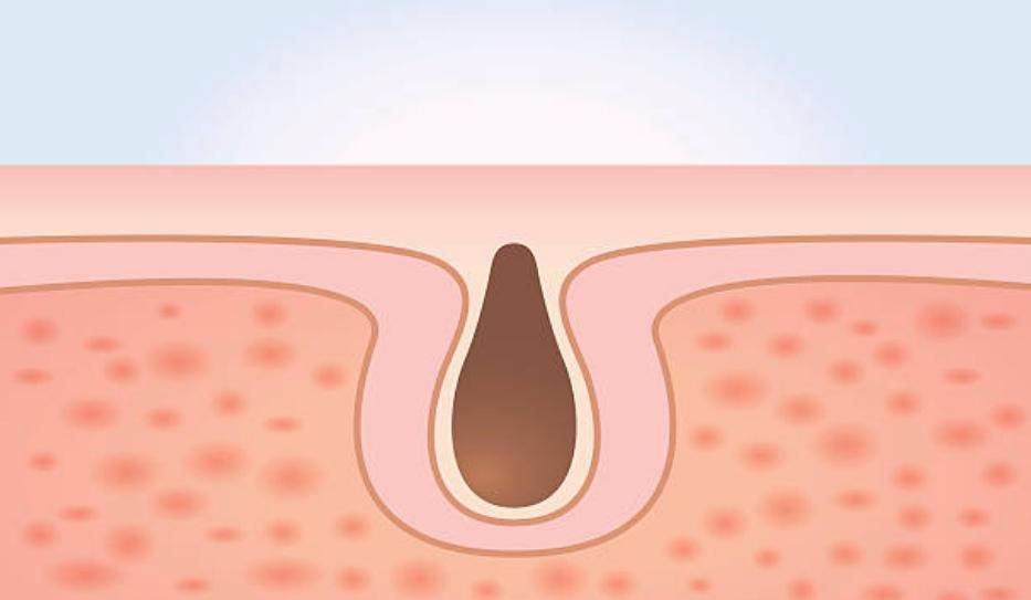 clogged pores as cause of ingrown hair cysts
