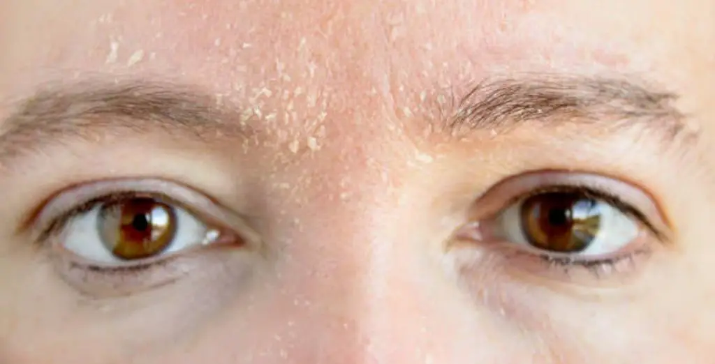 What are the risk factors towards developing eye brow dandruff