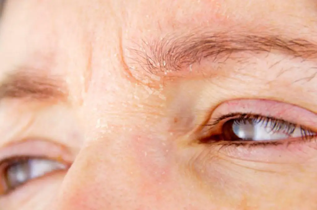 Eyebrow Dandruff Causes treatment and home remedies Treat n Heal