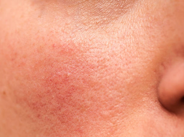 Rosacea with Acne - Causes, Treatment and Remedies