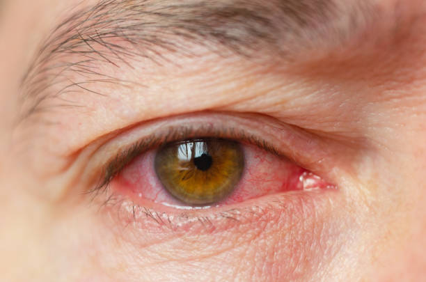 Early Symptoms of Pink Eye - challenge opening the eyes