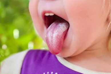 trush in baby mouth home remedies