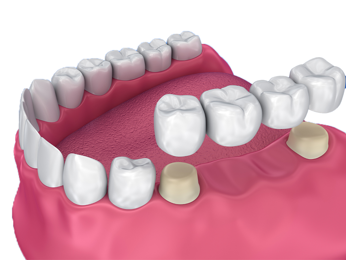 зубной мост 3 зуба